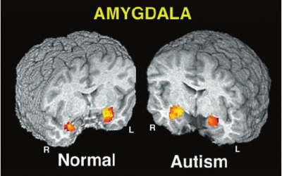 Anxiety, the Amygdala, and Autism