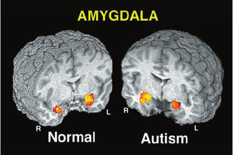 Anxiety, the Amygdala, and Autism